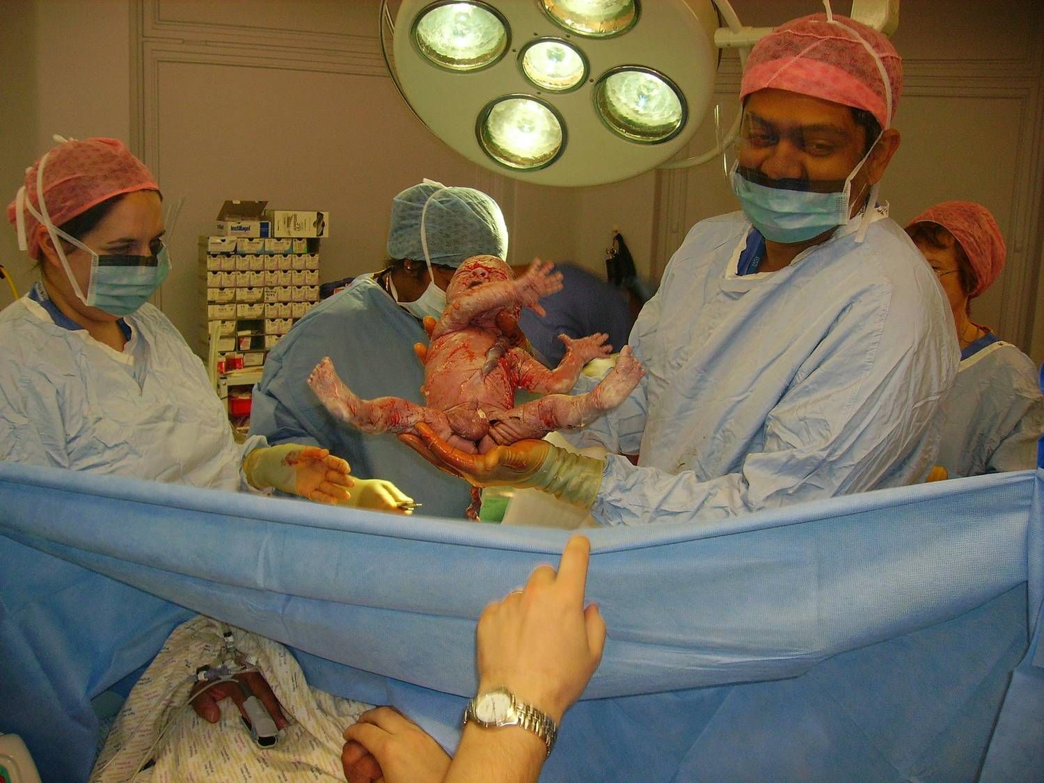 Newborn baby delivered during surgery with medical team in operating room