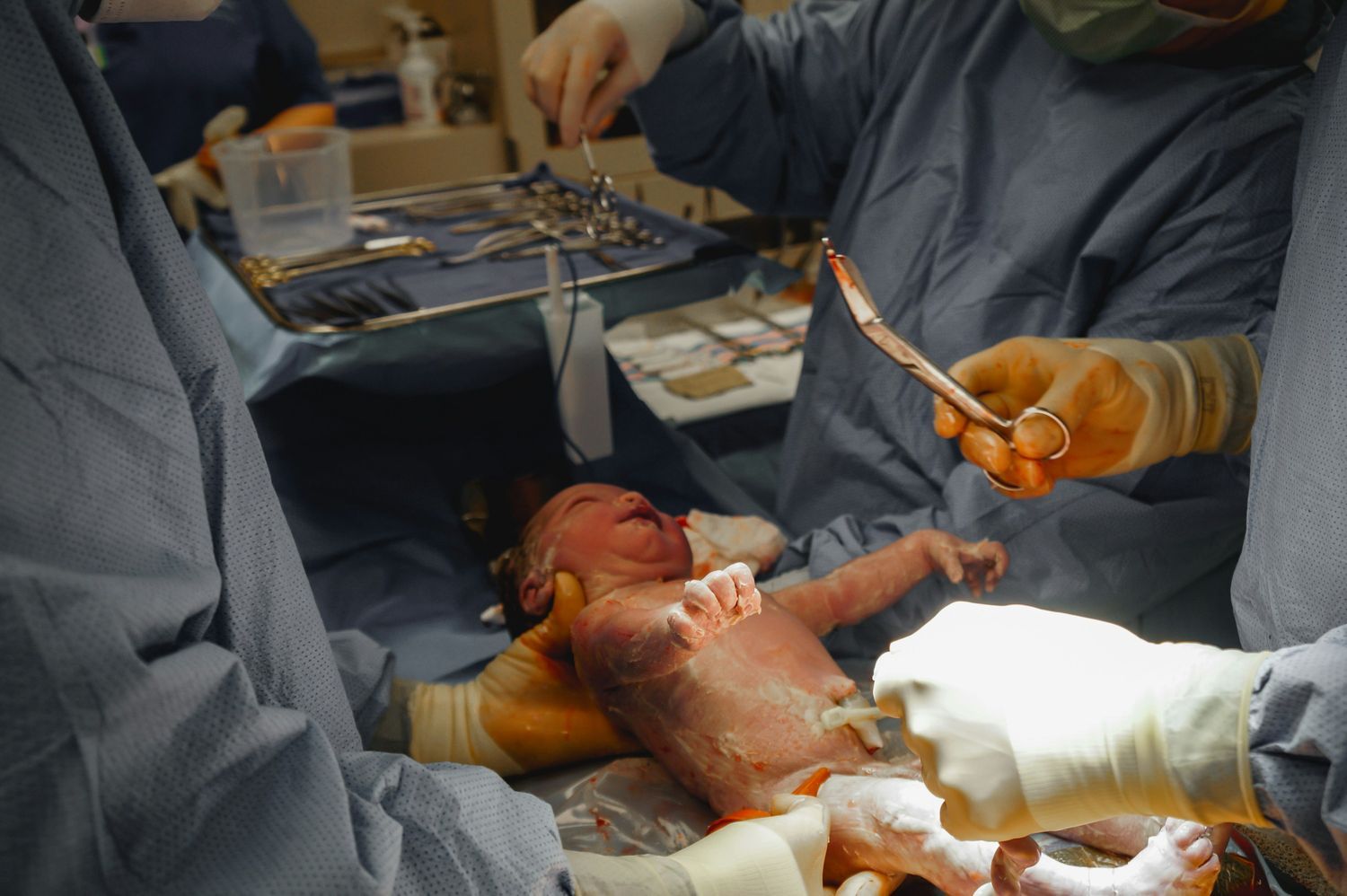 A newborn baby being delivered during a surgical childbirth procedure.
